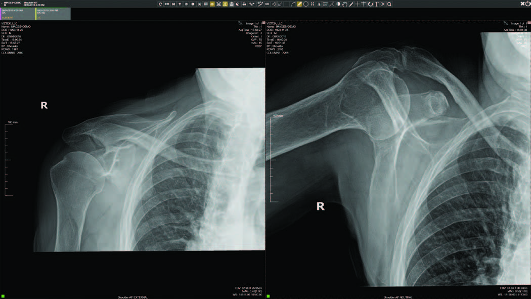 Exa Ortho Shoulder Images