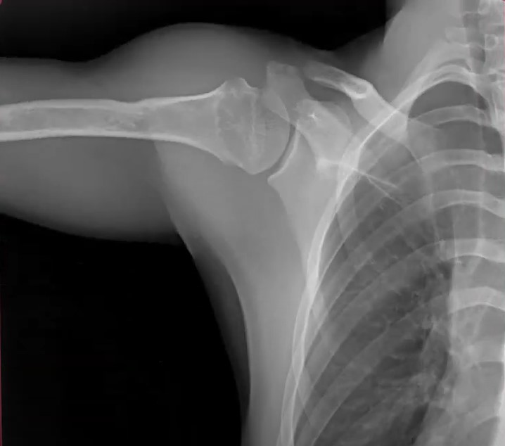 Shoulder x-ray from DDR system 3 of 3