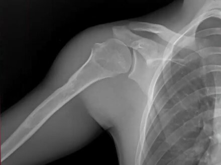 Shoulder x-ray from DDR system 2 of 3