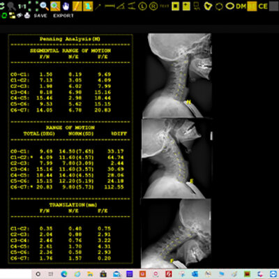 Opal-Chiro Pennings Analysis scree