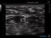 Anesthesia - RT Interscalene 3