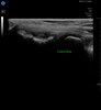 Lateral Elbow