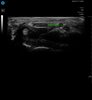 Median Nerve