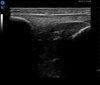 Patellar Tendon